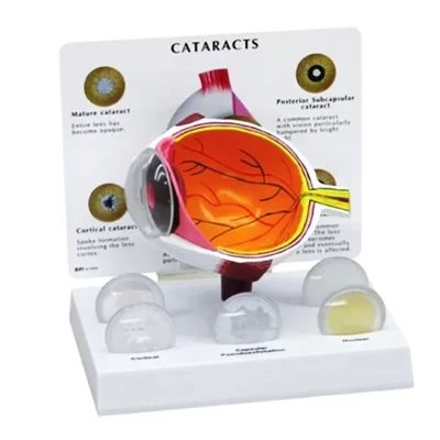 Modelo de ensino médico de anatomia da catarata olho humano de PVC 4X