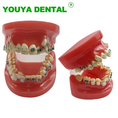 Modelo de ensino ortodôntico modelo de tratamento de dentes dentários com suportes de metal e cerâmica modelo tipodonte de maloclusão de odontologia quente