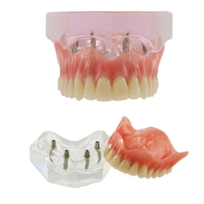Dentes dentários modelo implante com Overdenture restauração, ponte removível Demo Dental Education Model for Tooth Teaching Study