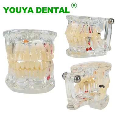 Modelo de demonstração dentária, doença, cárie, modelo de dentes faltantes, modelo de prática de implante para médico, dentista, comunicação de paciente
