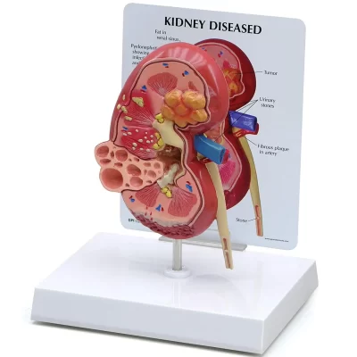 Modelo de patologias renais, réplica de anatomia do corpo humano, rim doente para médicos, ferramenta educacional de escritório, anatômicas gpi