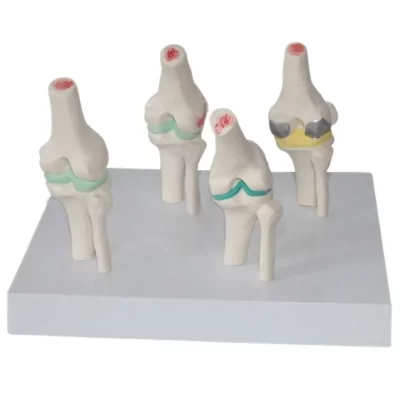 Dentária Médica Anatômica Humana 4 Estágio Osteoartrite Modelo Do Joelho