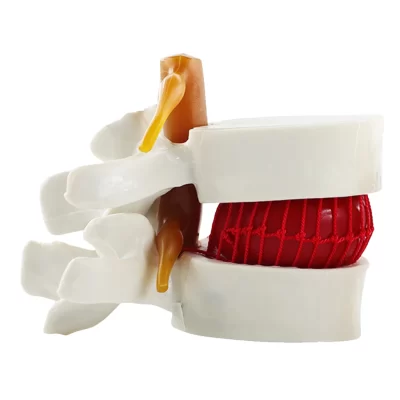 Modelo de hérnia de disco lombar humano, vértebras lombares, modelo 3d, manequim, disco intervertebral, coluna, modelos de hérnia anatômica
